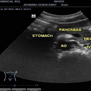 Ultrasound image of the epigastric region in longitudinal plane. This ...