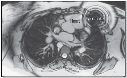 MRI and pacemakers: A risky mix - Harvard Health