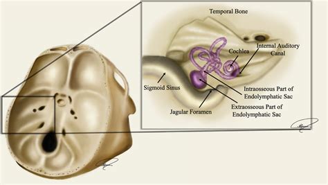 An illustration of the vestibular aqueduct | Download Scientific Diagram