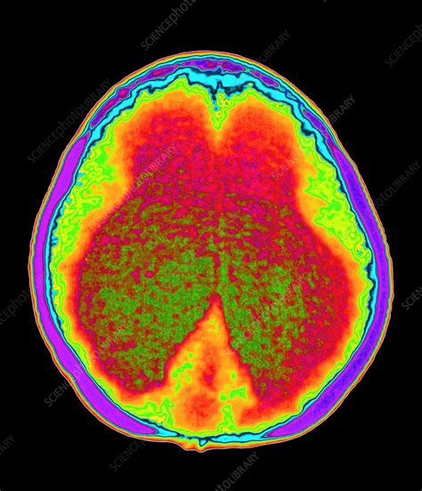 Hydrocephalus CT scan - Stock Image - M170/0249 - Science Photo Library