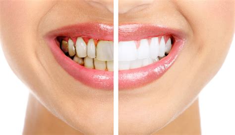 5 Home Remedies To Get Rid of Black Spots on Teeth - lifeberrys.com