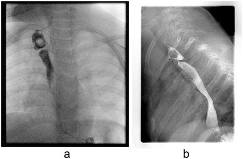 a Esophagogram AP view showing severe narrowing in upper third of... | Download Scientific Diagram