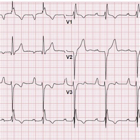 -ECG (2011). Sinus rhythm, right ventricular overload. | Download Scientific Diagram