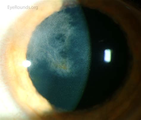 Ghost Vessels from Herpes Simplex Virus (HSV) Interstitial Keratitis