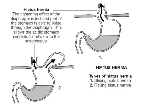 Hiatal Hernia - DSSurgery