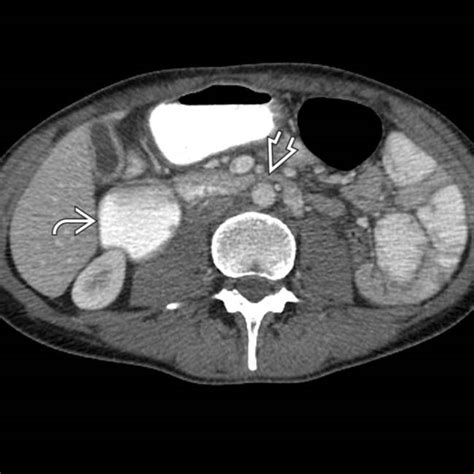 SMA Syndrome | Radiology Key