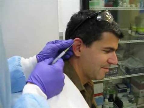 Cauliflower Ear Draining - YouTube