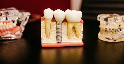 3D Printed Teeth: Revolutionizing Dentistry - 3D Insider