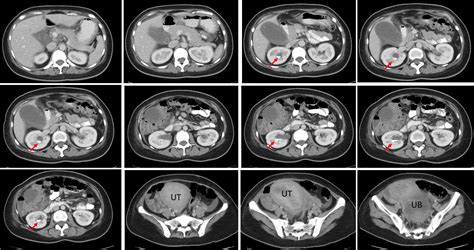 Renal milk of calcium – Radiology Cases