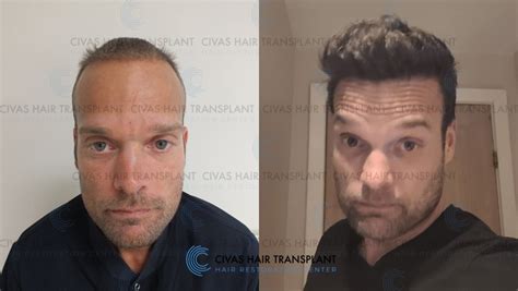 Civas Hair Transplant- FUE Hair Transplant Before & After Pictures (3200 Grafts) | Hair loss ...