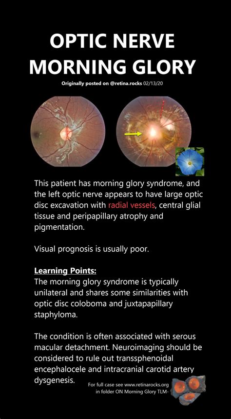 Optic Nerve Disorders > Morning Glory Syndrome - Retina Rocks