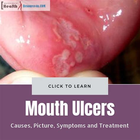 Mouth Ulcers : Causes, Picture, Symptoms And Treatment in 2021 | Mouth ...