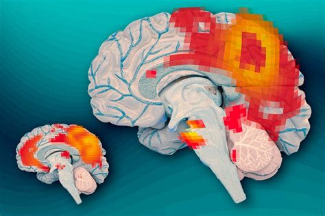 Inside the adult ADHD brain | MIT News | Massachusetts Institute of Technology