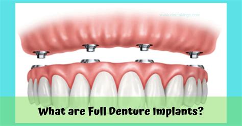 What are Full Denture Implants? - Denta Kings