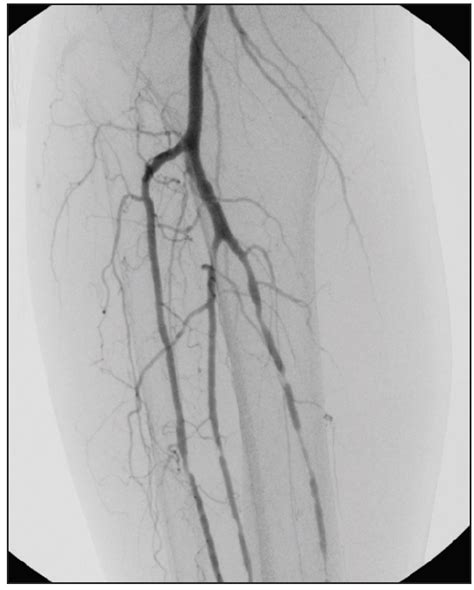 Anterior Tibial Artery