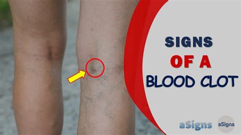 10 Signs Of Blood Clot