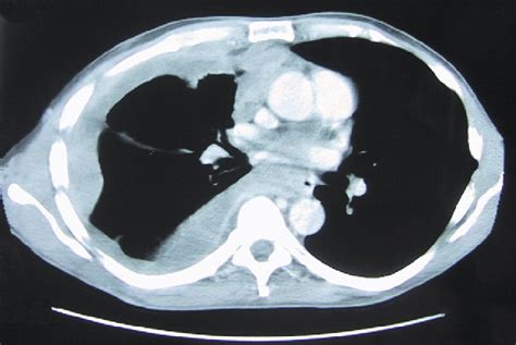 Mesothelioma Ct Scan - Example Of A Patient With Right Sided Mpm ...