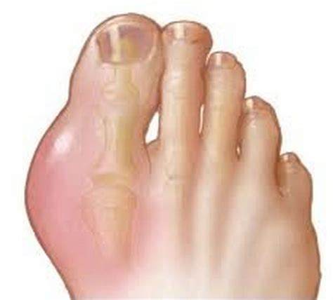 👉 Sprained Toe - Symptoms (Vs broken big toe), Treatment (December 2021)