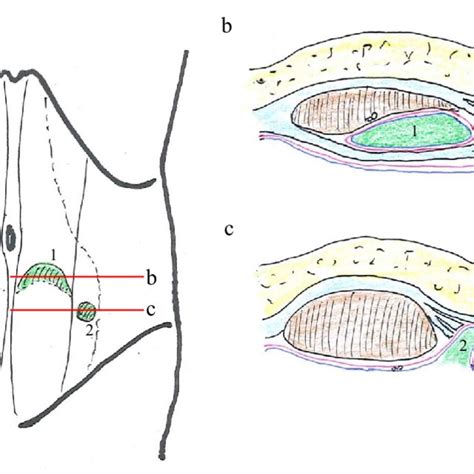 Anatomical location of arcuate line hernia (1) and Spigelian hernia... | Download Scientific Diagram