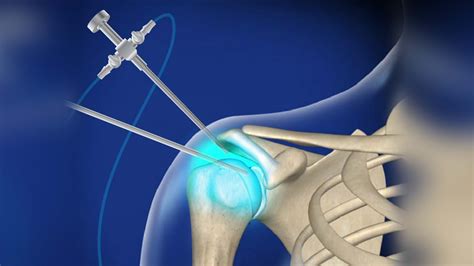 What is a Shoulder Arthroscopy?