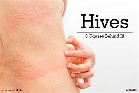 Hives Rash or Urticuria - 6 Cause Behind Skin Disorder - By Kaya Skin ...