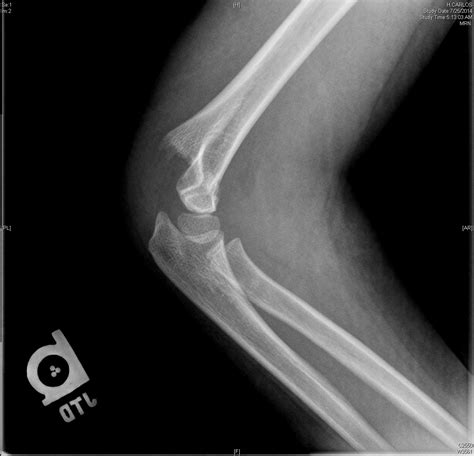 Supracondylar Fracture - Pediatric - Pediatrics - Orthobullets