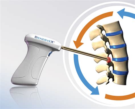 Facet Joint Denervation - Spines Dorset