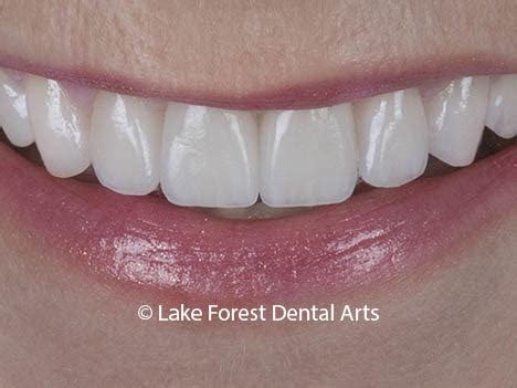 Porcelain Crowns-Types, Uses, Costs | Beautiful and Natural