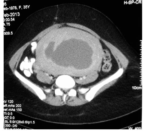 MRI (cross section): a large intramural leiomyoma with areas of cystic... | Download Scientific ...