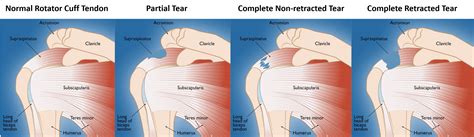 When Not to Have Rotator Cuff Surgery? - Regenexx