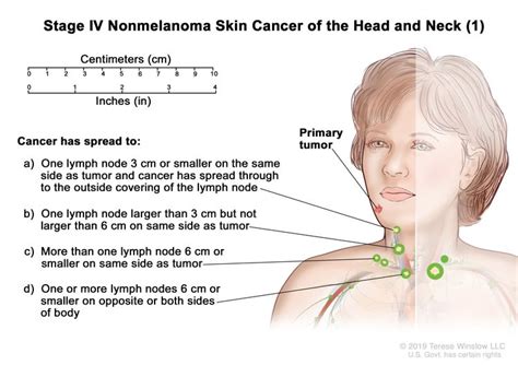 Skin Cancer | Vanderbilt-Ingram Cancer Center