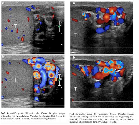 EVALUASI VARICOCELE ULTRASOUND – radiologi.id