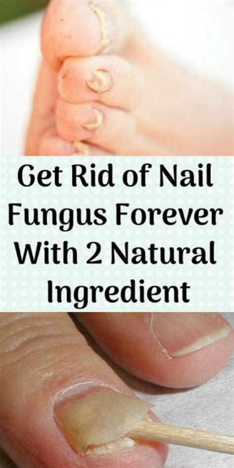 Get Rid Of Nail Fungus Forever With 2 Natural IngredientA fungal nail ...