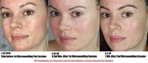 After 2 Microneedling Treatments – Life and DIY