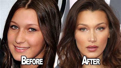 Bella Hadid Before and After Plastic Surgery Including Nose Job and Lips - Famous Plastic Surgeries