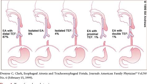 [PDF] Anesthetic Consideration on Neonatal Patient with Esophageal Atresia | Semantic Scholar