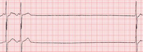 Sinus Arrest - ECG Made Simple