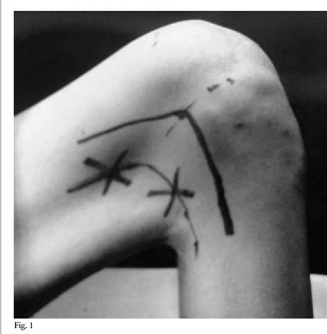 Figure 1 from Treatment of knee flexion contracture due to central nervous system disorders in ...