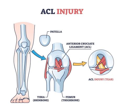 ACL Tear Injury: Symptoms, Recovery, And Prevention, Acl, 11/29/2022