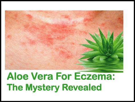 aloe-vera-eczema-1 - Disfreeskin