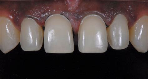 Ceramic Veneers: Tooth Preparation for Enamel Preservation