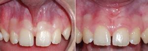 What is the difference between frenotomy, frenectomy and frenuloplasty? | News | Dentagama