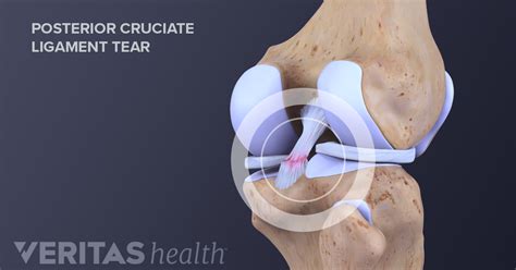 Symptoms of Posterior Cruciate Ligament (PCL) Tears