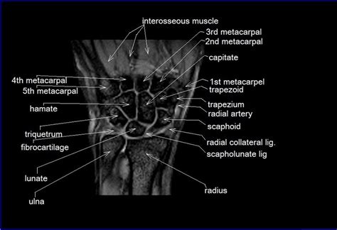 MRI Wrist Coronal Anatomy | Wrist tendon and ligaments Cross sectional ...