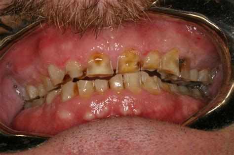 Rotten Teeth - Pictures, Symptoms, Causes, Treatment | Diseases Pictures