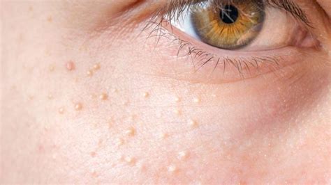 What Are These White Spots on My Face? | Advanced Dermatology