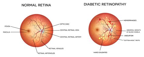 Diabetic Retinopathy and Vitrectomy - Monterey, CA