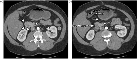 Annular Pancreas Ultrasound