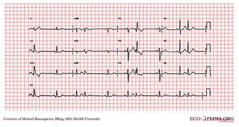 Electrocardiogram Showed Ectopic Atrial Rhythm Atrial Premature ...