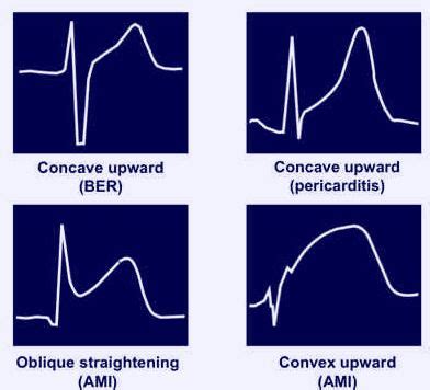 ECG changes in Pericarditis | Epomedicine